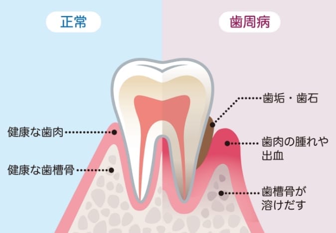 歯周病の説明図